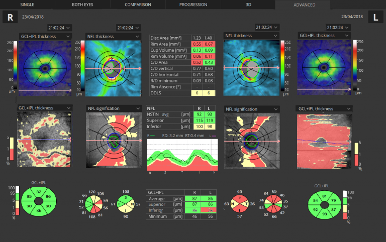 GLAUCOMA-Advance-Retina-ONH-768x482.png